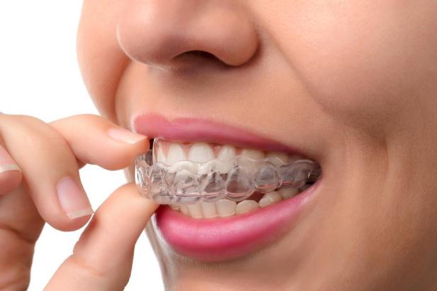 A More Discreet Way to Straighten Your&nbsp;Smile
